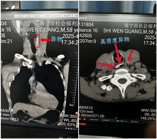 食道异物险窒息，放射科影像精准定位助力“拆弹”